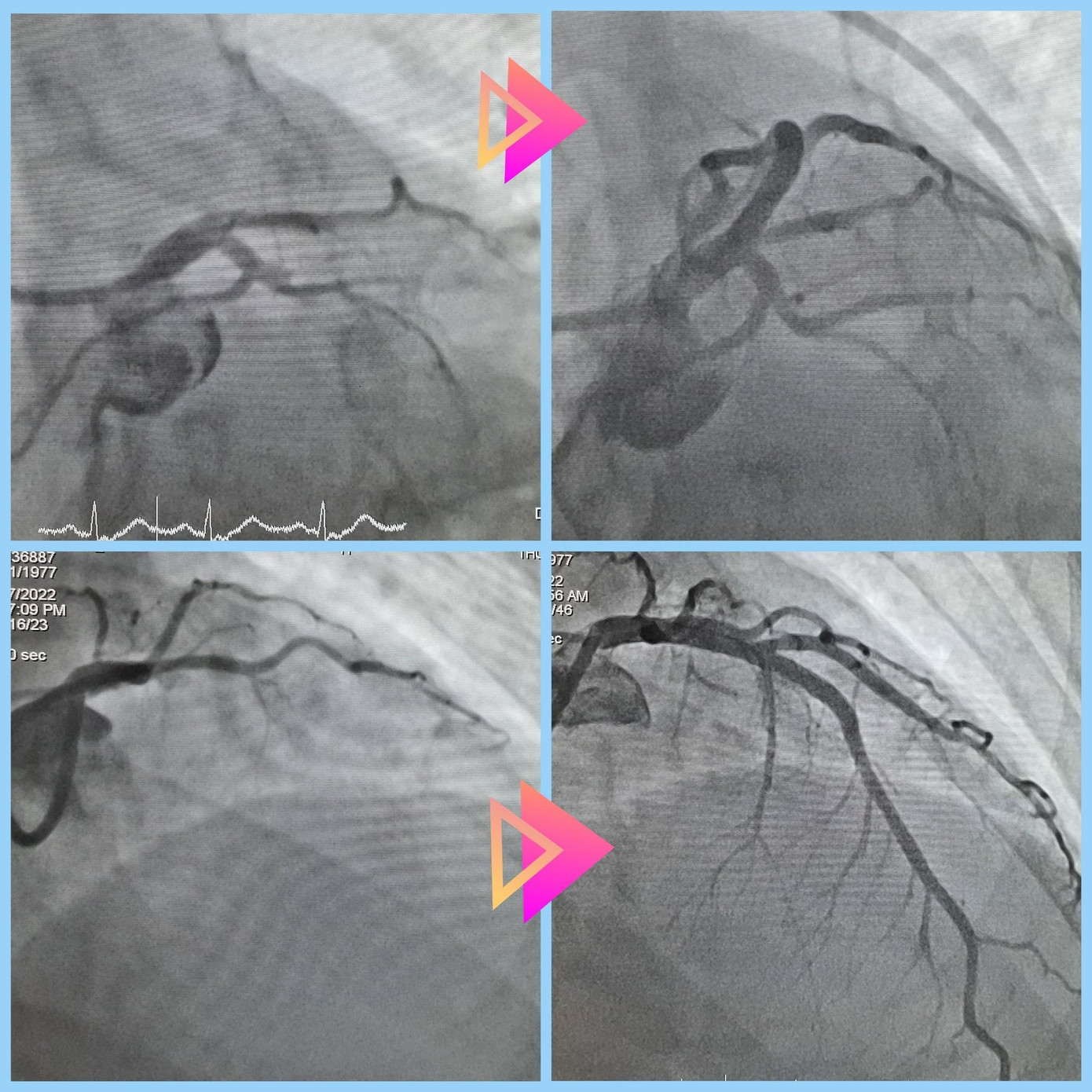 Mạch máu của bệnh nhân trước (hình trên) và sau can thiệp (hình dưới) nhồi máu cơ tim cấp Mạch máu của bệnh nhân trước (hình trên) và sau can thiệp (hình dưới) nhồi máu cơ tim cấp