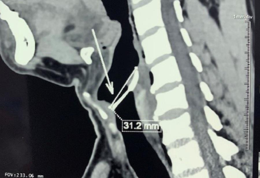 Chiếc xương cá dài hơn 3 cm ghim vào thanh quản của bệnh nhân sau khi hóc sặc Chiếc xương cá dài hơn 3 cm ghim vào thanh quản của bệnh nhân sau khi hóc sặc