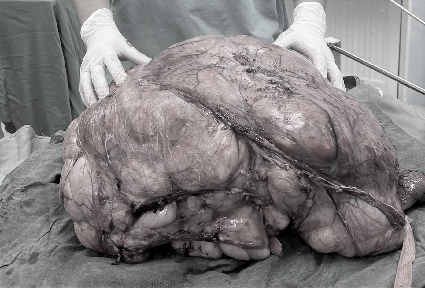 Các bác sĩ đã bóc tách thành công khối u khổng lồ ra khỏi cơ thể người bệnh Các bác sĩ đã bóc tách thành công khối u khổng lồ ra khỏi cơ thể người bệnh