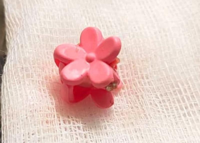 Dị vật là chiếc kẹp tóc đã gây viêm nhiễm được lấy ra khỏi âm đạo của bệnh nhi (ảnh: BVCC) Dị vật là chiếc kẹp tóc đã gây viêm nhiễm được lấy ra khỏi âm đạo của bệnh nhi (ảnh: BVCC)