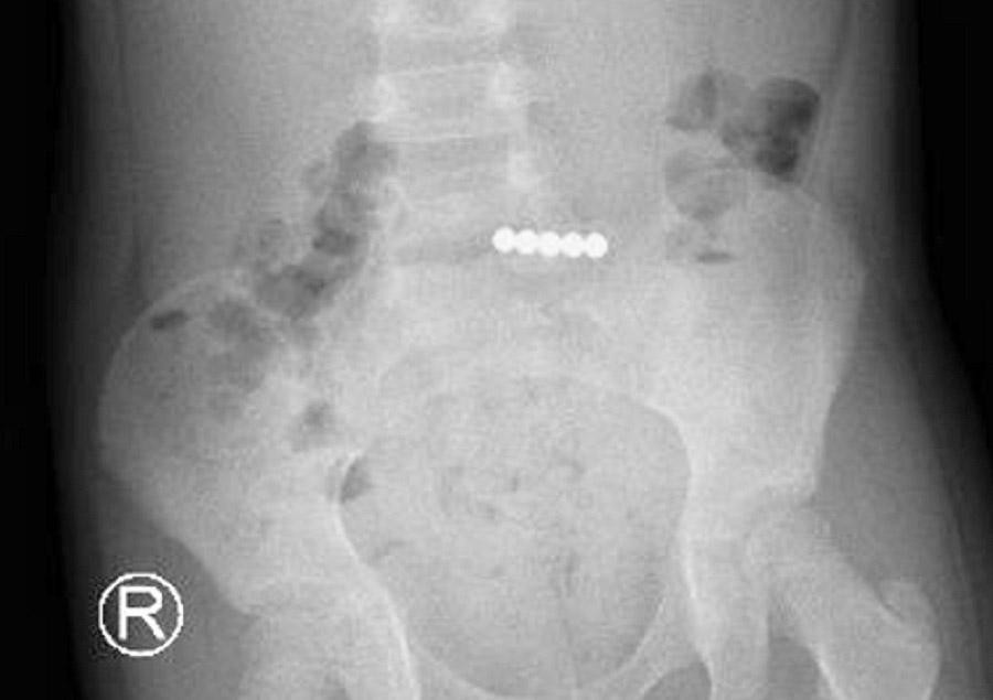 Khi đang ngậm trong miệng, bệnh nhi đã sơ ý nuốt cả 5 viên bi vào đường tiêu hóa