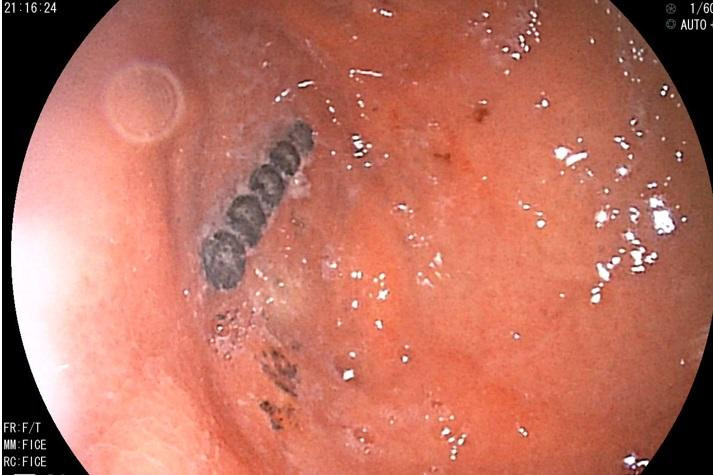 Hình ảnh trên camera nội soi cho thấy 5 viên bi dính chặt vào nhau trong đường ruột bệnh nhi