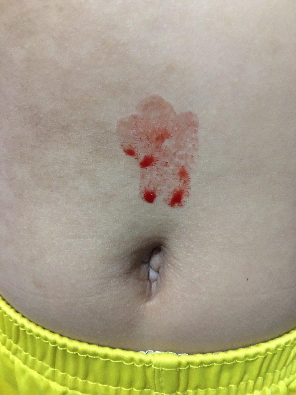 Bệnh nhi đột ngột chảy máu ở vùng bụng khiến gia đình hoang mang (ảnh: BVCC) Bệnh nhi đột ngột chảy máu ở vùng bụng khiến gia đình hoang mang (ảnh: BVCC)