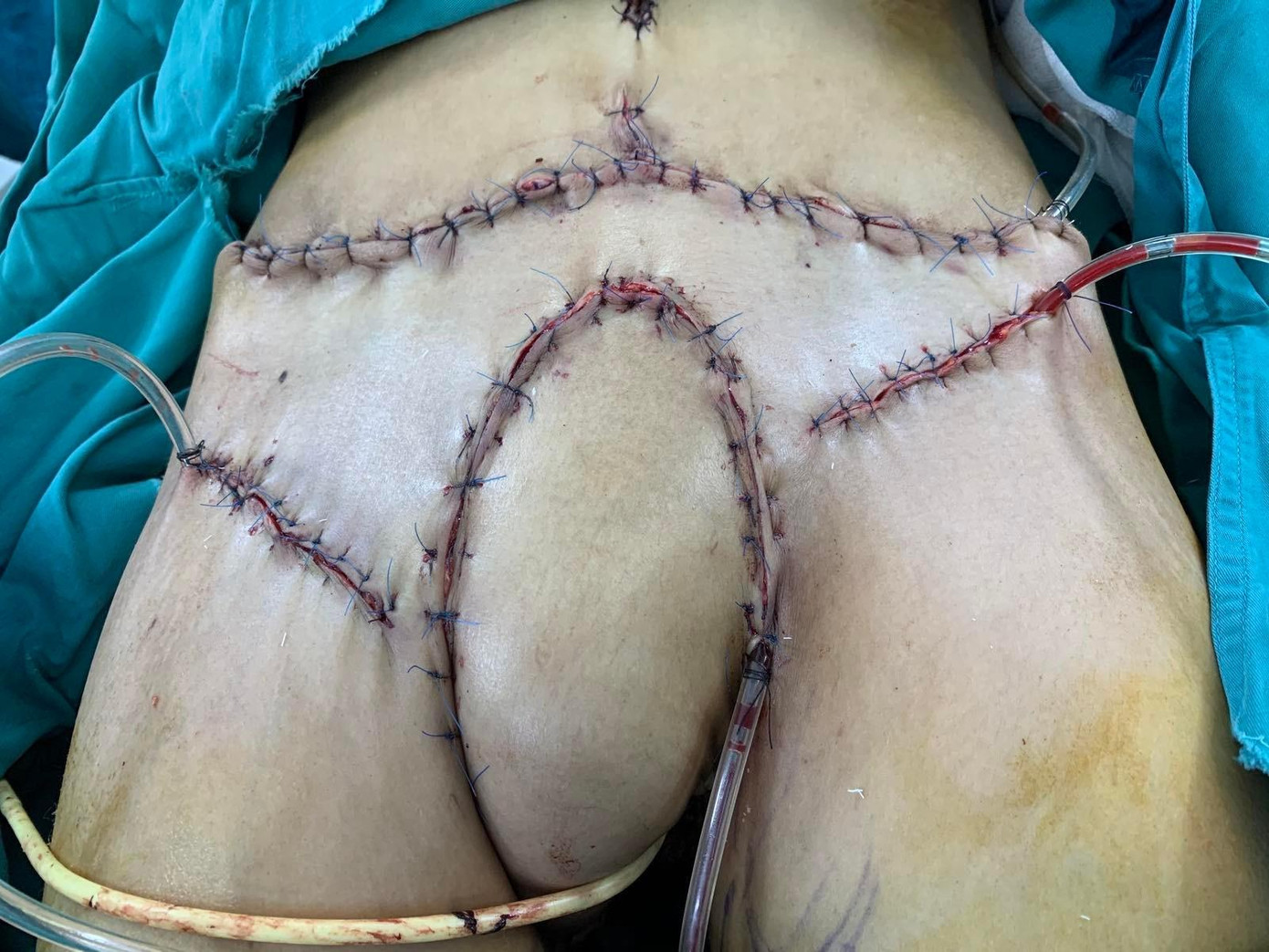 Bệnh nhân đã phải trải qua cuộc đại phẫu để bóc khối u ung thư khỏi cơ thể (ảnh: BSCC) Bệnh nhân đã phải trải qua cuộc đại phẫu để bóc khối u ung thư khỏi cơ thể (ảnh: BSCC)