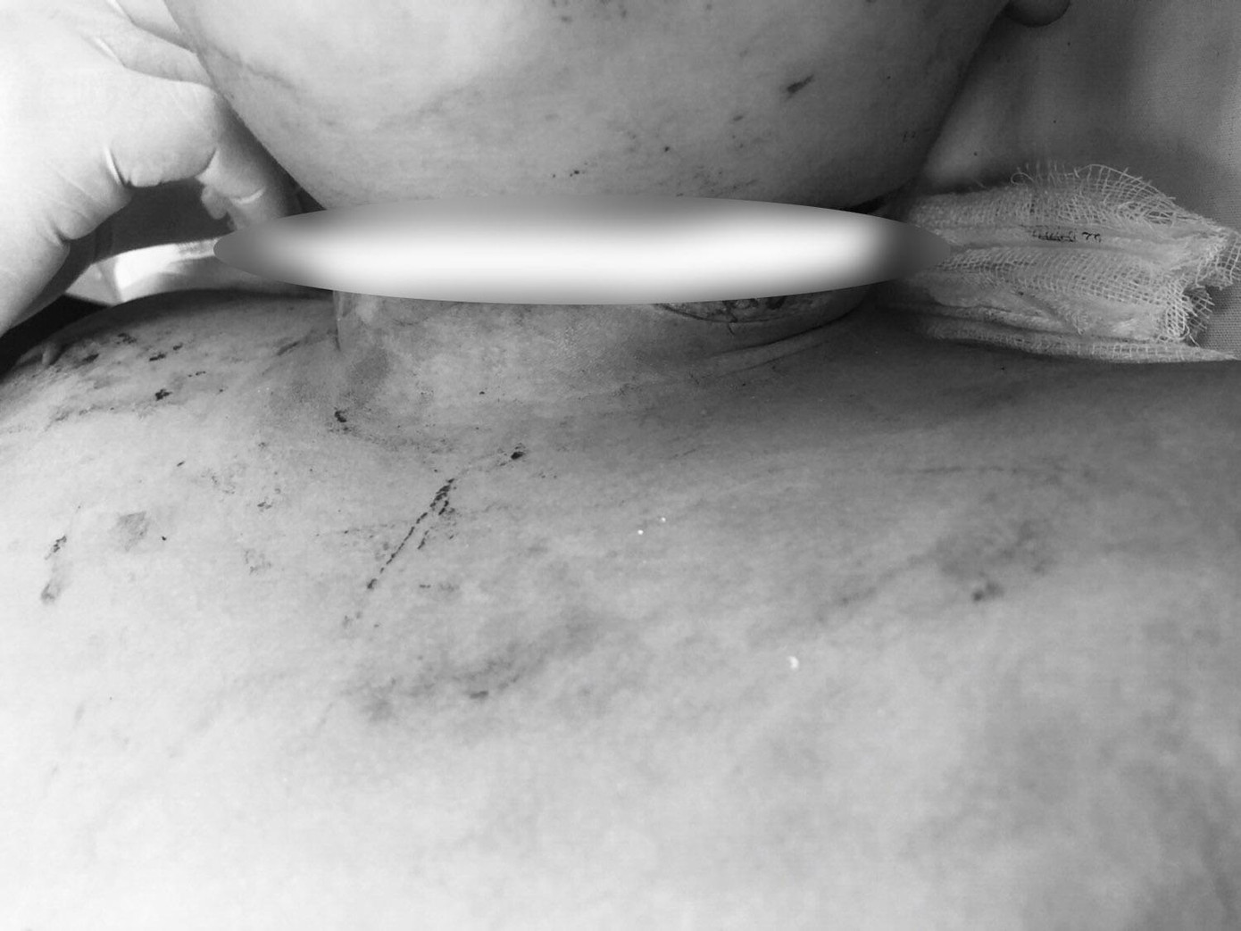 Bệnh nhi nhập viện với vết cắt ngang cổ dài 15cm (ảnh: BVCC) Bệnh nhi nhập viện với vết cắt ngang cổ dài 15cm (ảnh: BVCC)