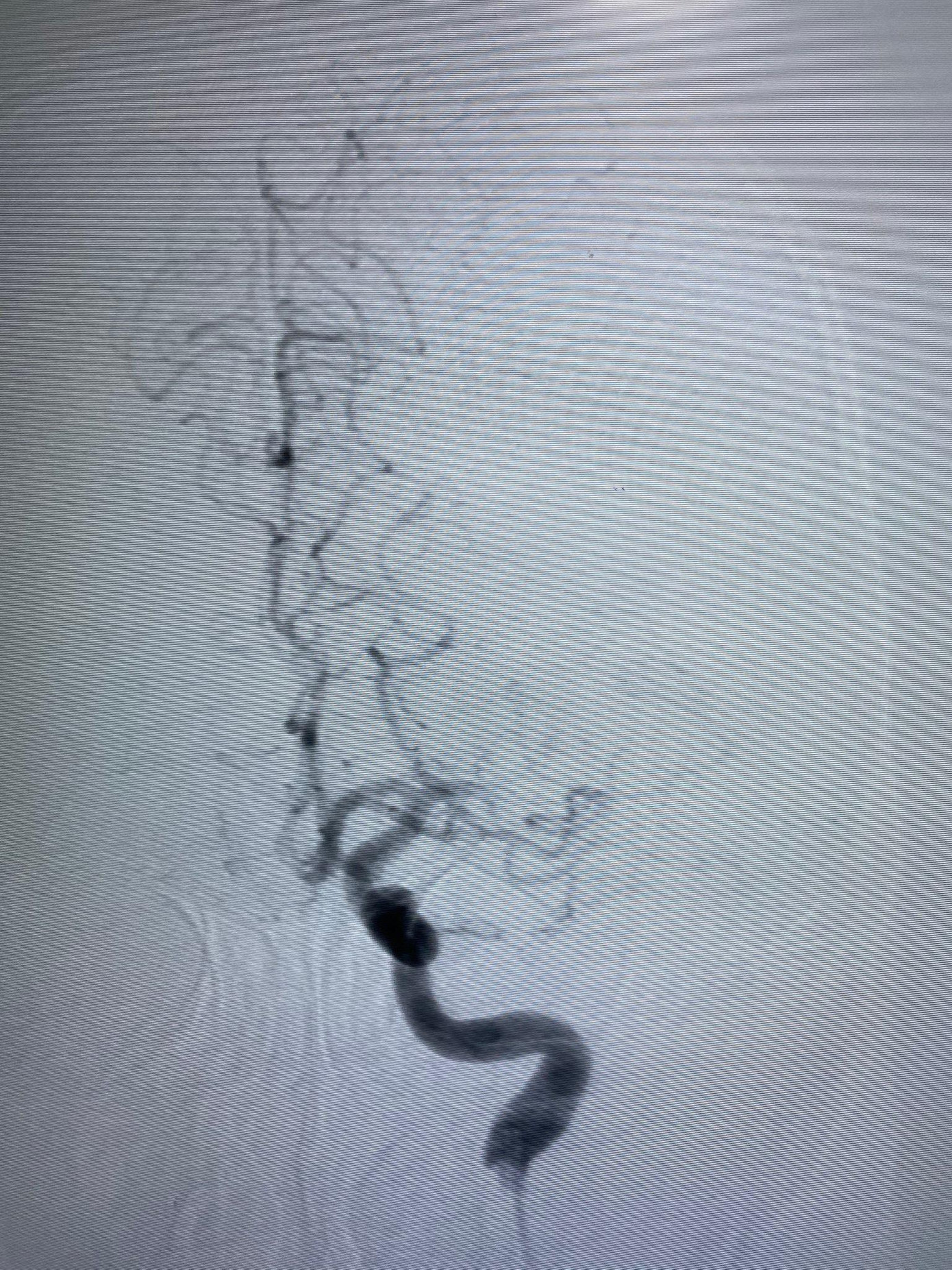 Động mạch não giữa bên trái của bệnh nhân bị tắc thời điểm nhập viện cấp cứu