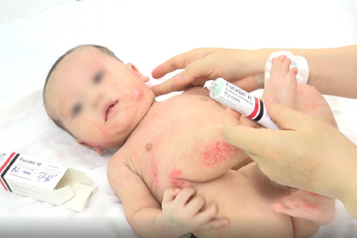 Bé trai 4 tháng tuổi phải nhập viện điều trị ngay sau khi được phụ huynh đưa đến khám Bé trai 4 tháng tuổi phải nhập viện điều trị ngay sau khi được phụ huynh đưa đến khám