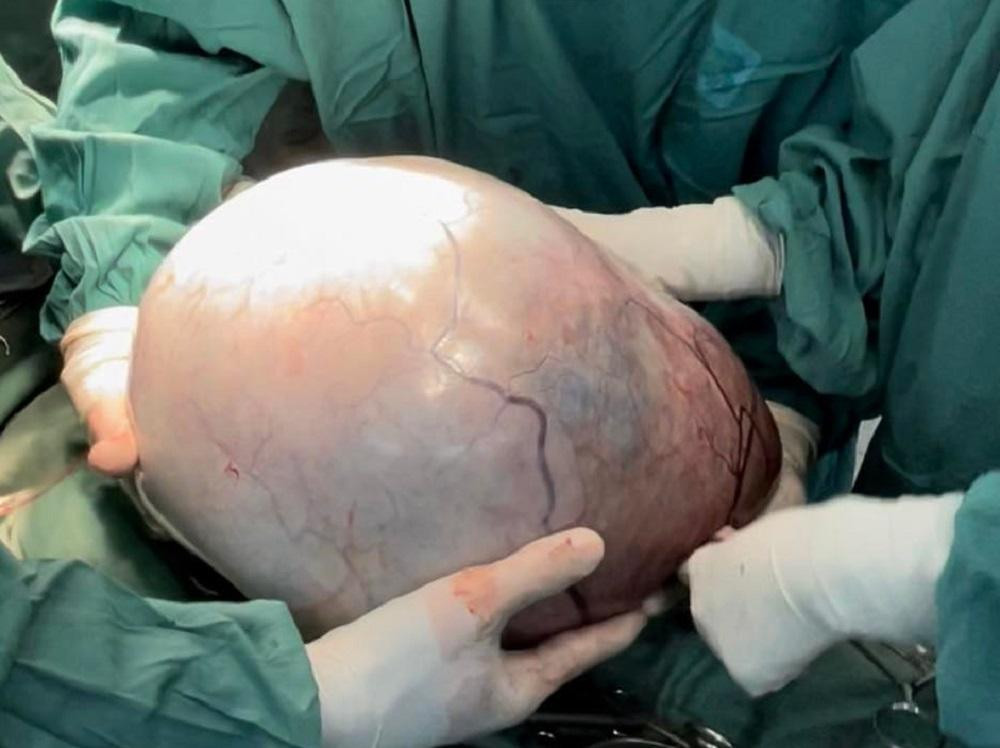 Khối u khổng lồ được bác sĩ thực hiện phẫu thuật bóc tách thành công khỏi cơ thể bệnh nhân Khối u khổng lồ được bác sĩ thực hiện phẫu thuật bóc tách thành công khỏi cơ thể bệnh nhân