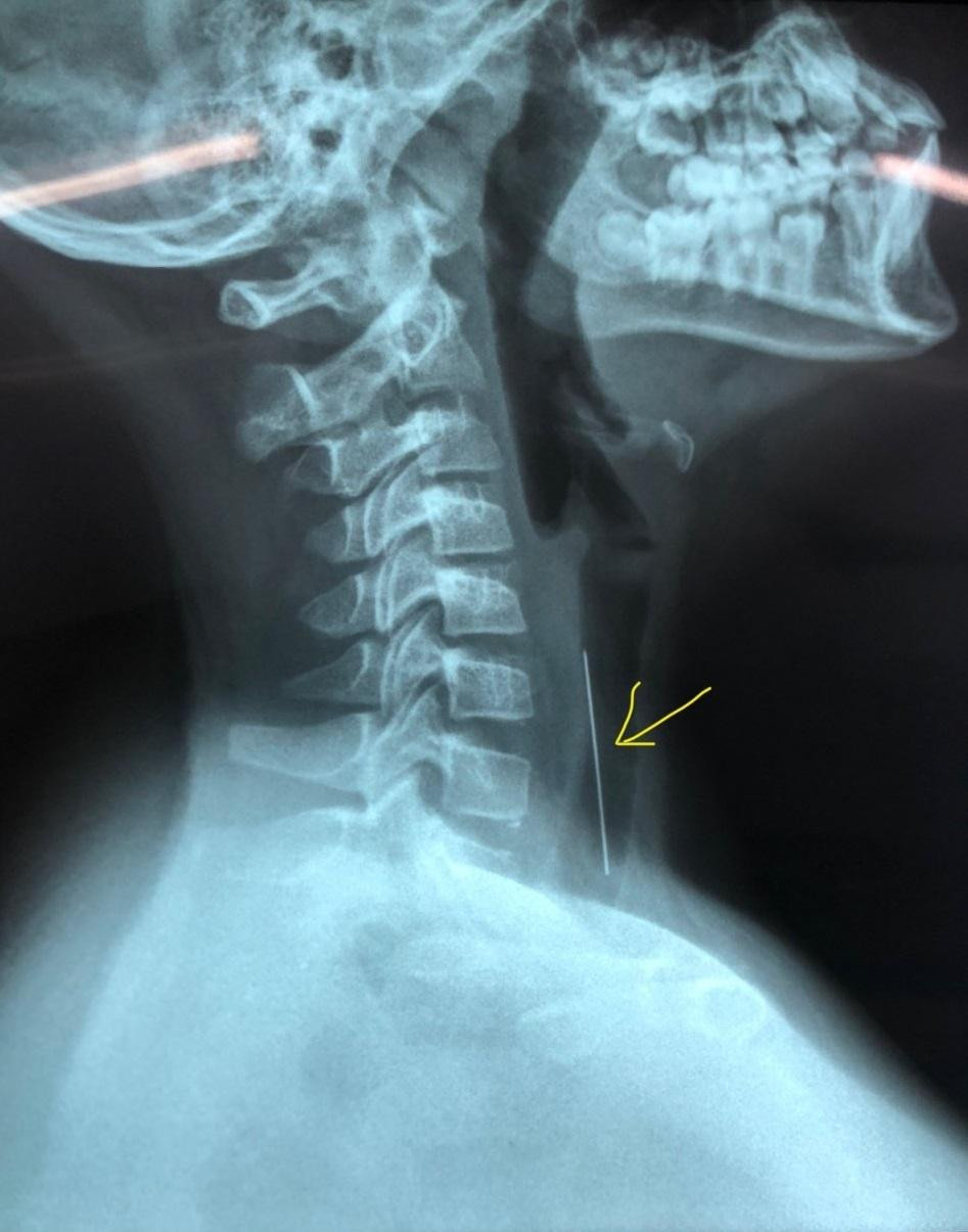 Hình ảnh kiểm tra cho thấy cây kim dài gần 5cm ghim vào khí quản của bệnh nhi