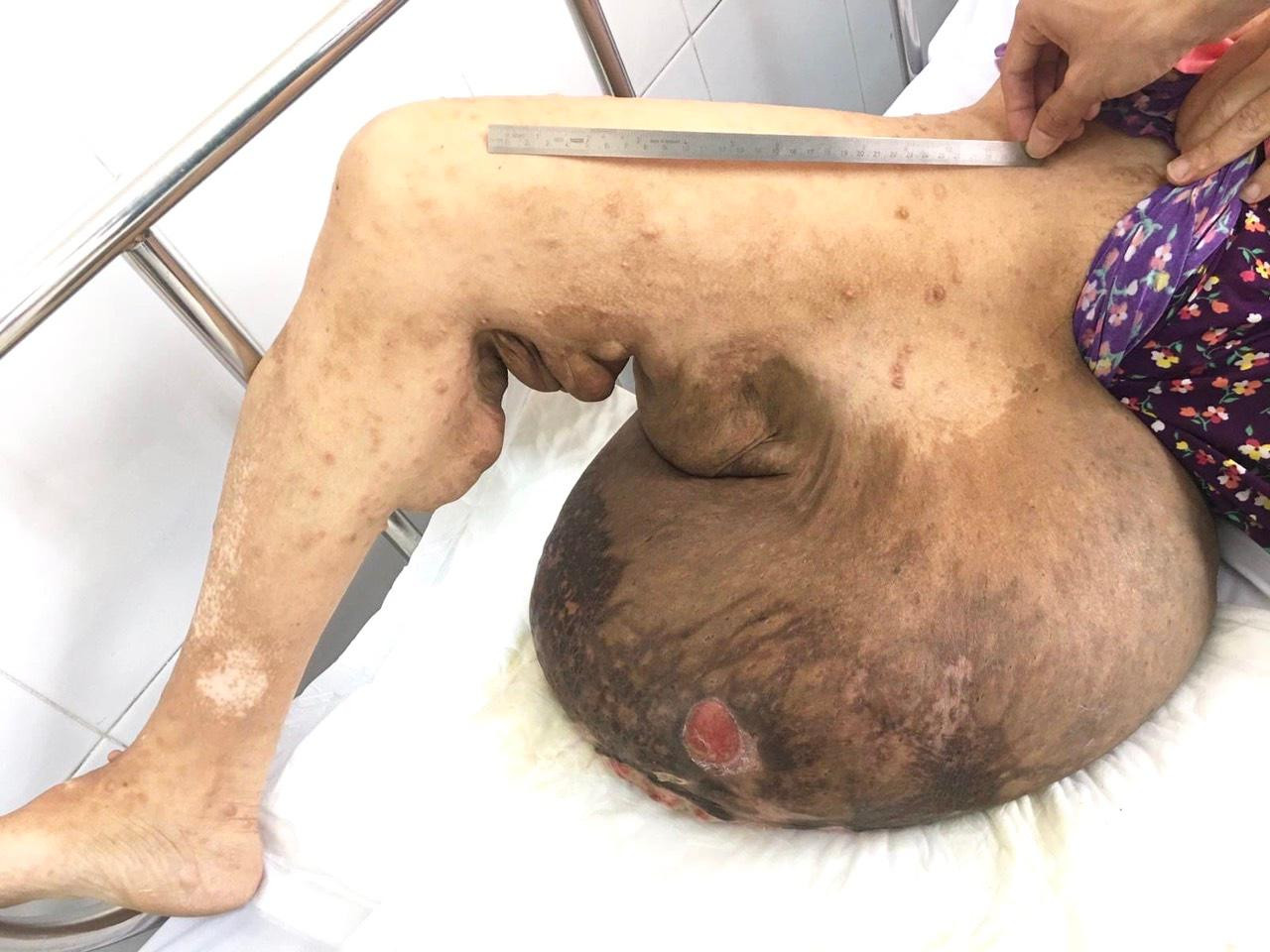 Một trường hợp bị u sợi thần kinh khổng lồ từng điều trị tại Bệnh viện Chợ Rẫy Một trường hợp bị u sợi thần kinh khổng lồ từng điều trị tại Bệnh viện Chợ Rẫy