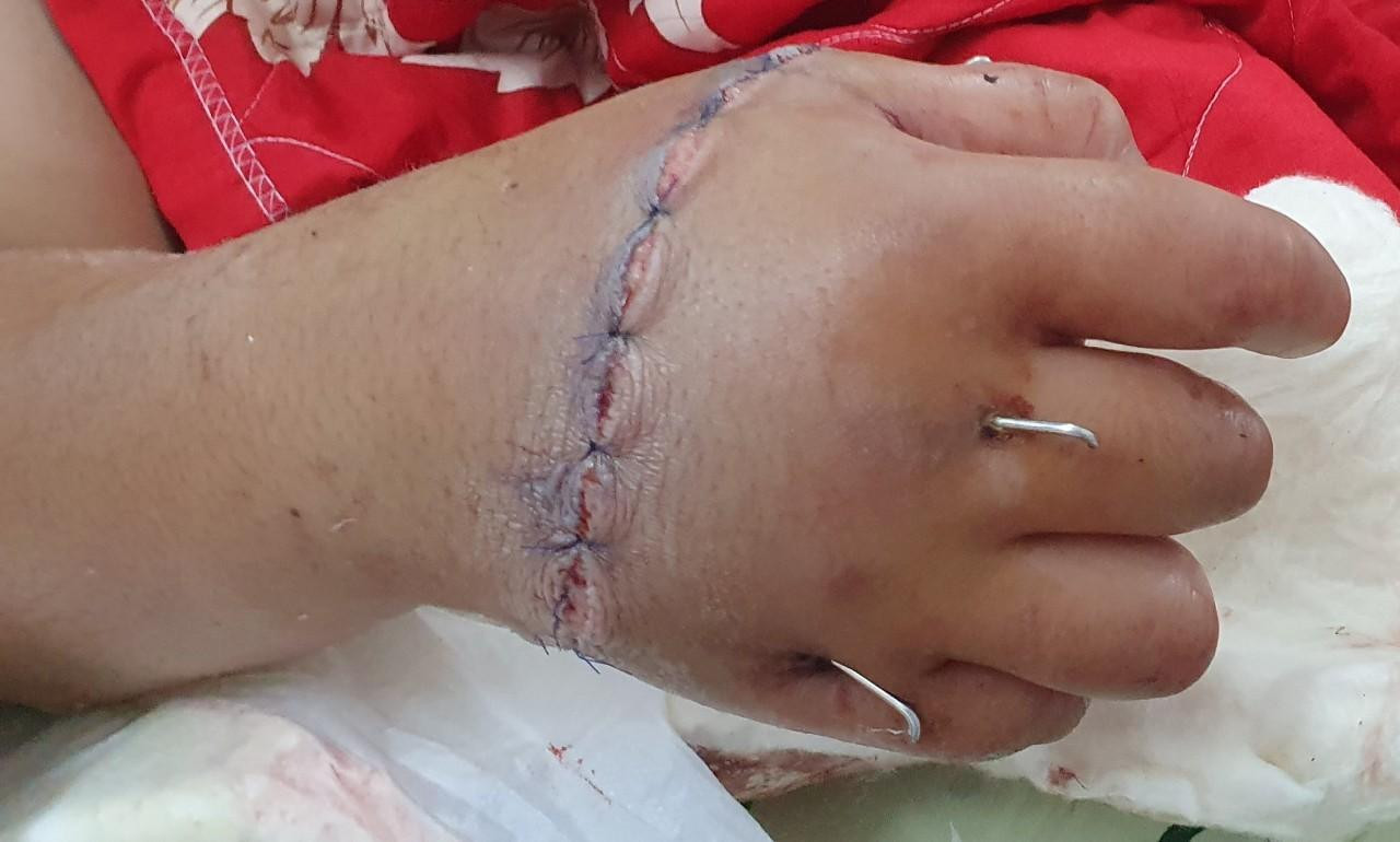 Sau 10 ngày phẫu thuật, bàn tay của bệnh nhân đã sống hoàn toàn, các ngón cử động tốt