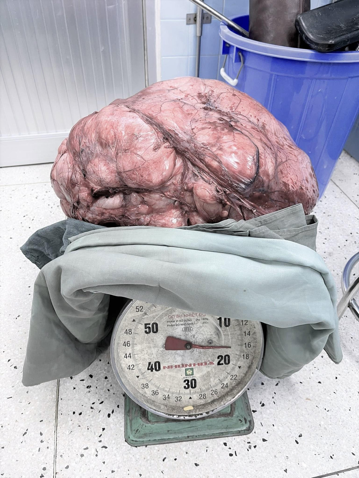 Đây là một trong những khối u lớn nhất từng gặp ở nam giới từ trước đến nay tại Bệnh viện Ung Bướu Đây là một trong những khối u lớn nhất từng gặp ở nam giới từ trước đến nay tại Bệnh viện Ung Bướu