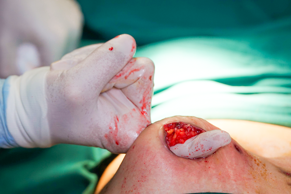 Ổ nhiễm trùng lớn khiến bệnh nhân đau đớn, sau 2 tháng chịu đựng, chị đã được phẫu thuật