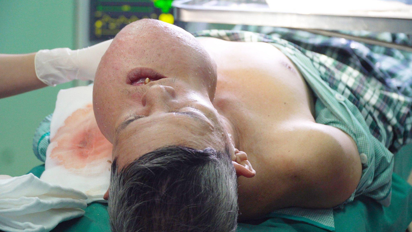 Các bác sĩ đang tìm phương án can thiệp thì khối u bị vỡ khiến người bệnh phải nhập viện cấp cứu Các bác sĩ đang tìm phương án can thiệp thì khối u bị vỡ khiến người bệnh phải nhập viện cấp cứu