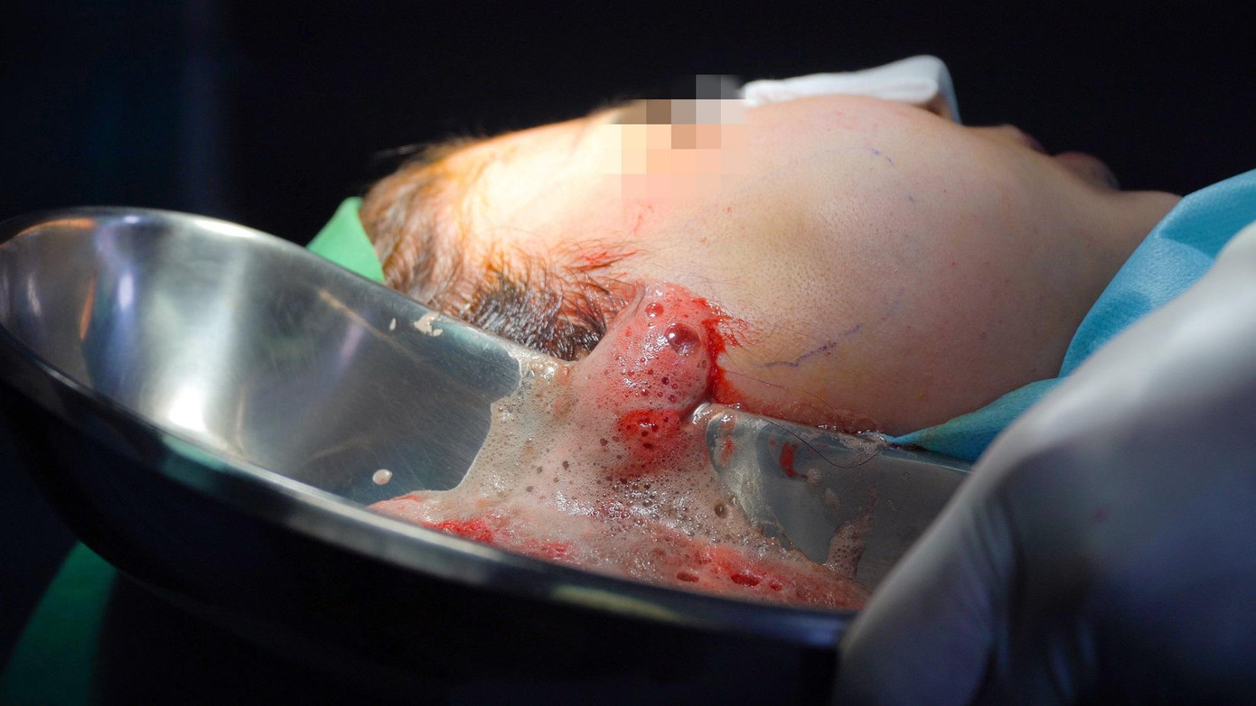 Mặt bệnh nhân trào mủ khi bác sĩ tiến hành rạch da nạo vét ổ nhiễm trùng Mặt bệnh nhân trào mủ khi bác sĩ tiến hành rạch da nạo vét ổ nhiễm trùng