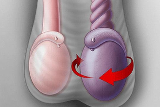Xoắn tinh hoàn là tình trạng khá phổ biến ở các bé trai. Cha mẹ nên chủ động phát hiện sớm để can thiệp sớm cho trẻ Xoắn tinh hoàn là tình trạng khá phổ biến ở các bé trai. Cha mẹ nên chủ động phát hiện sớm để can thiệp sớm cho trẻ