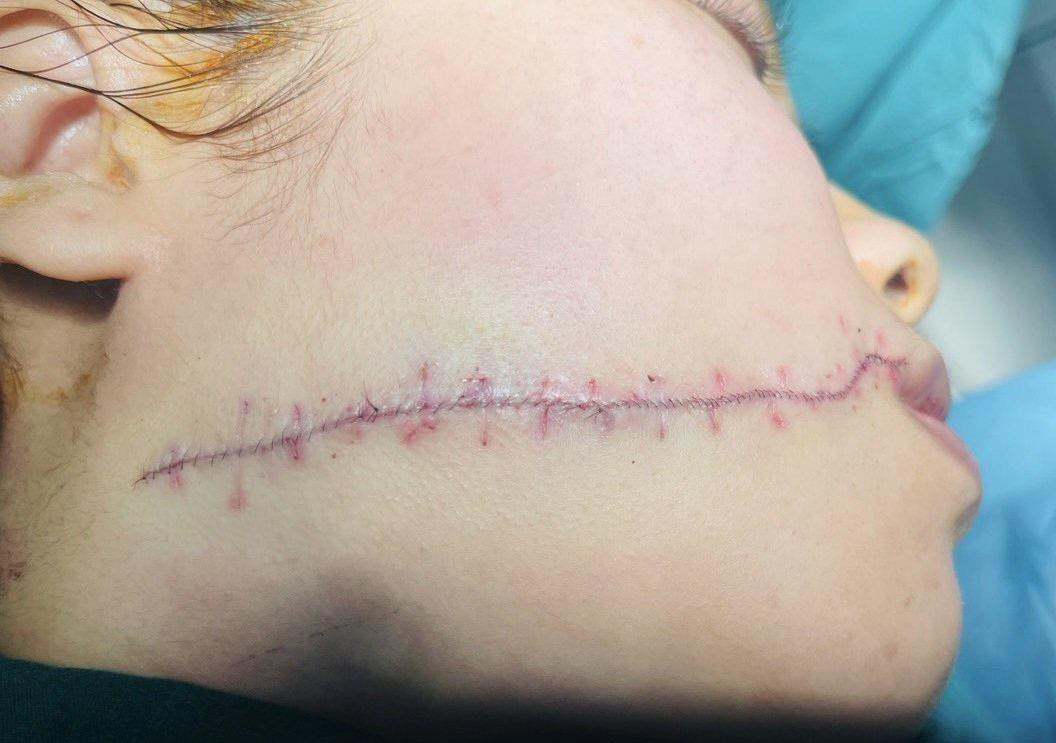 Các bác sĩ đã thực hiện hàng trăm mũi khâu thẩm mỹ để hạn chế di chứng cho người bệnh Các bác sĩ đã thực hiện hàng trăm mũi khâu thẩm mỹ để hạn chế di chứng cho người bệnh
