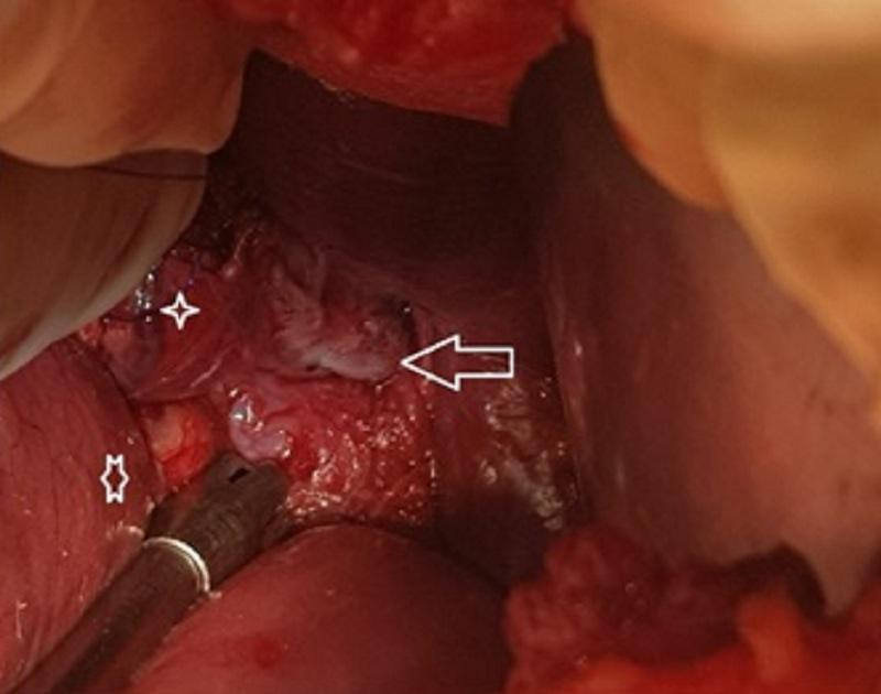 Vị trí thực quản bị vỡ của bệnh nhân được bác sĩ phát hiện trên camera nội soi Vị trí thực quản bị vỡ của bệnh nhân được bác sĩ phát hiện trên camera nội soi