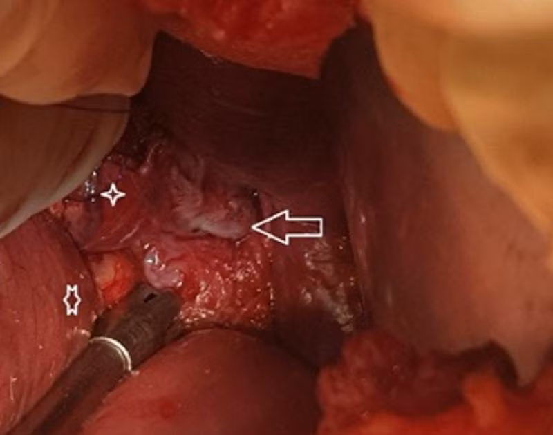 Vị trí thực quản bị vỡ của bệnh nhân được bác sĩ phát hiện trên camera nội soi