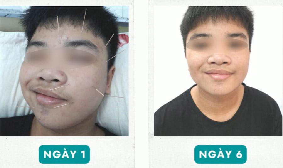 Nam sinh trước và sau điều trị tình trạng liệt dây thần kinh số VII