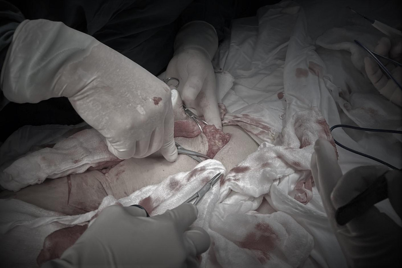 Vết loét vùng cùng cụt của bệnh nhân suốt 10 năm sau xạ trị đã không thể lành Vết loét vùng cùng cụt của bệnh nhân suốt 10 năm sau xạ trị đã không thể lành