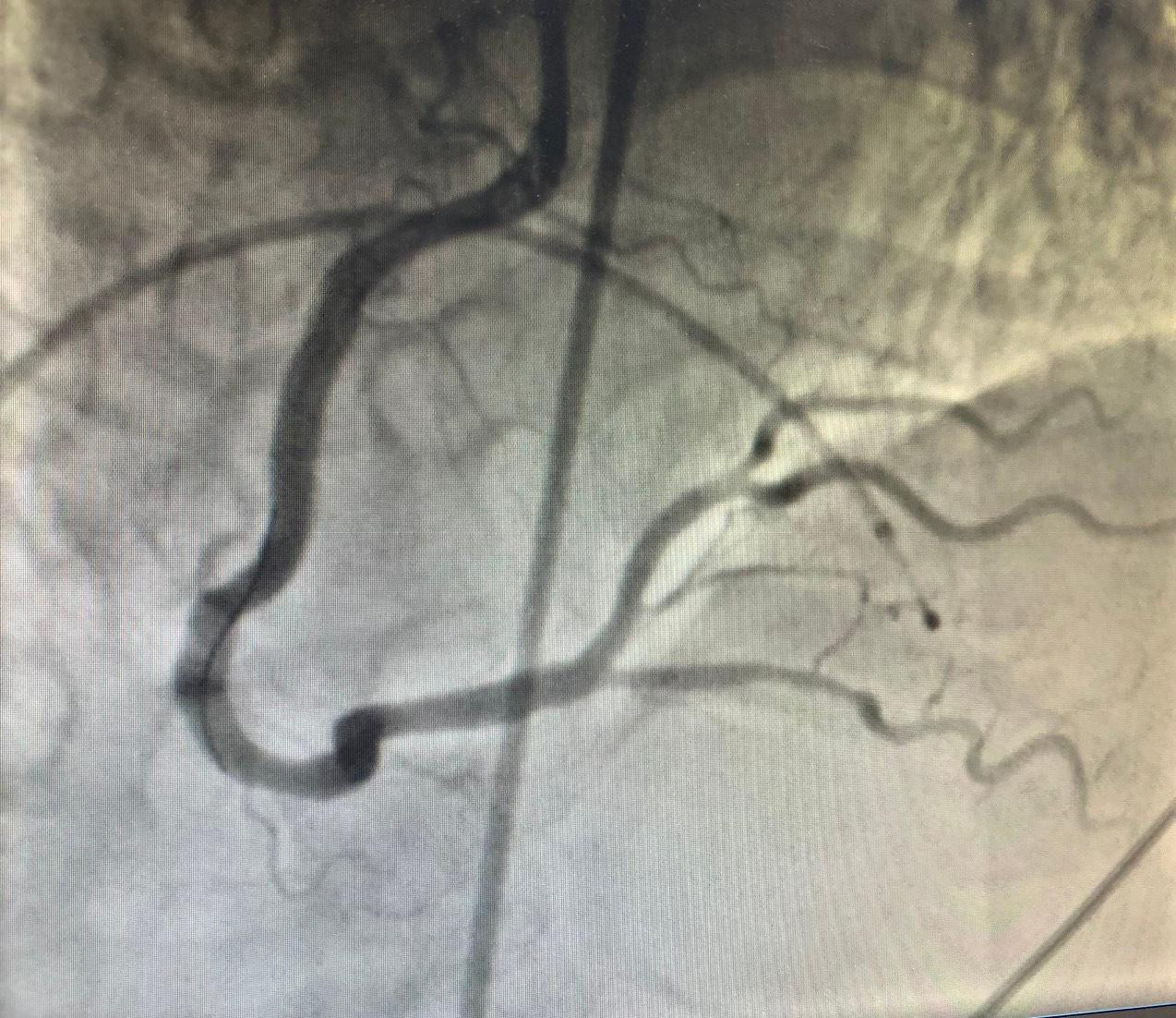 Mạch vành của bệnh nhân (hình trên) bị tắc nghẽn trước can thiệp và được tái thông sau can thiệp (hình dưới)