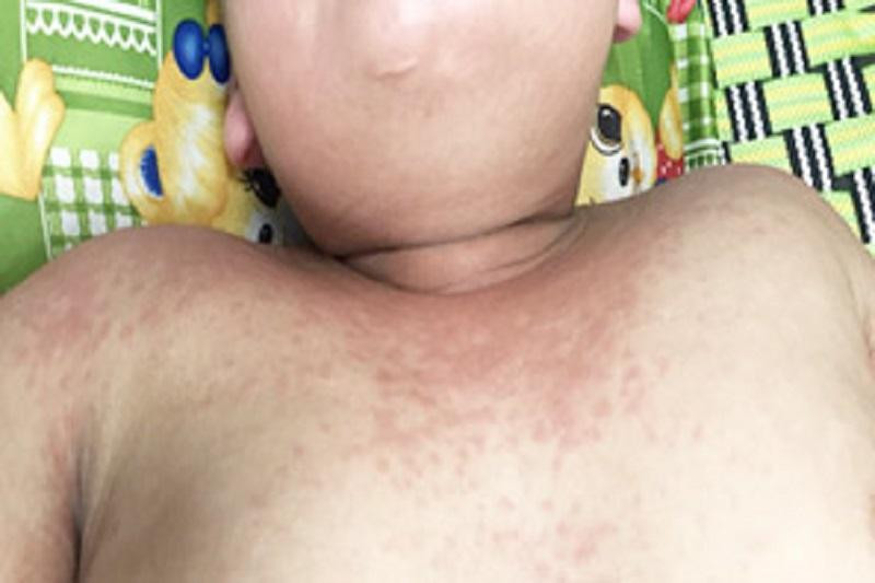 Sốt cao, nổi mẩn đỏ trên cơ thể là biểu hiện của viêm đa hệ thống ở trẻ, phụ huynh cần đặc biệt lưu ý Sốt cao, nổi mẩn đỏ trên cơ thể là biểu hiện của viêm đa hệ thống ở trẻ, phụ huynh cần đặc biệt lưu ý