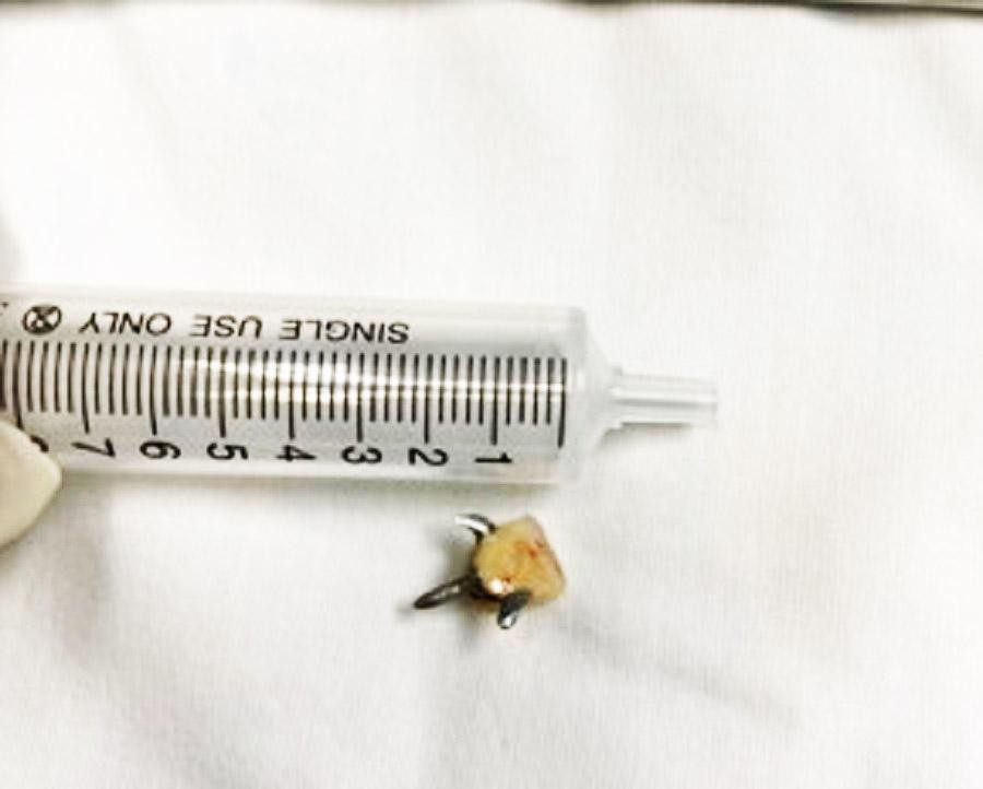 Chiếc răng giả 3 chân được bác sĩ thực hiện nội soi lấy ra khỏi đường thở của bệnh nhân