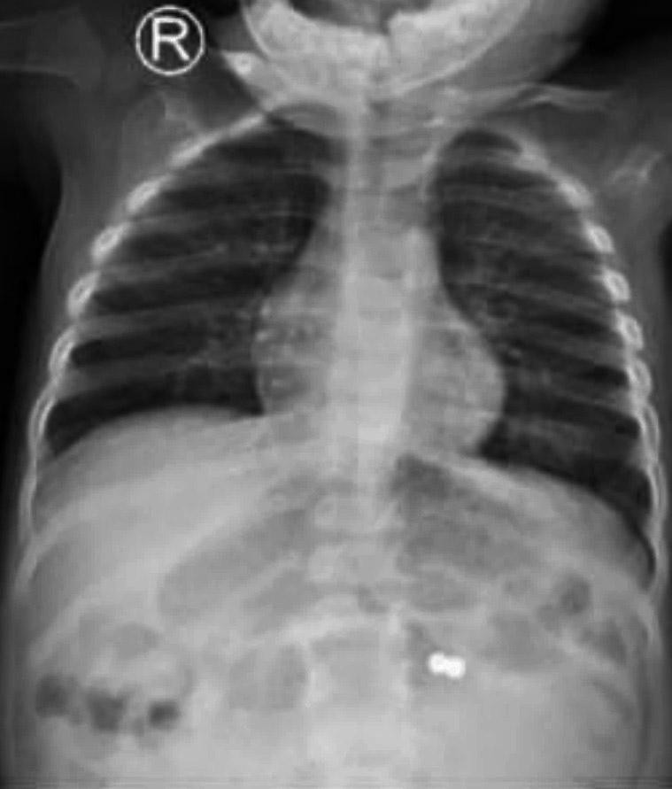 Nuốt bi nam châm là tai nạn rất nguy hiểm, nhiều trẻ đã bị thủng ruột Nuốt bi nam châm là tai nạn rất nguy hiểm, nhiều trẻ đã bị thủng ruột