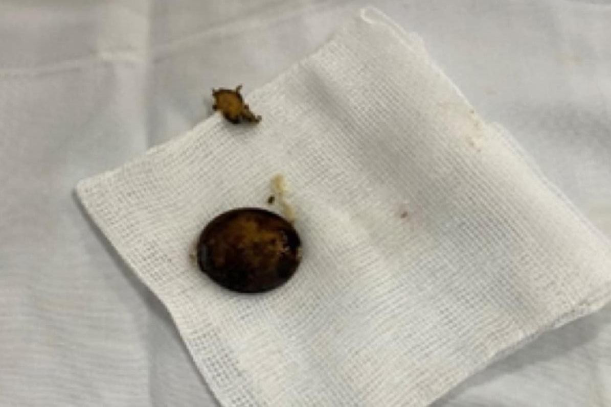 Dị vật đã gỉ sét được lấy ra khỏi thực quản, trẻ may mắn không phải đối mặt với tổn thương nghiêm trọng Dị vật đã gỉ sét được lấy ra khỏi thực quản, trẻ may mắn không phải đối mặt với tổn thương nghiêm trọng