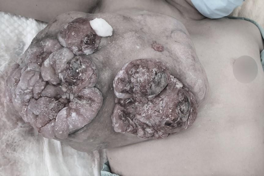 Nữ bệnh nhân nhập viện với khối u lớn ở vùng ngực phải đang lở loét, trào mủ Nữ bệnh nhân nhập viện với khối u lớn ở vùng ngực phải đang lở loét, trào mủ