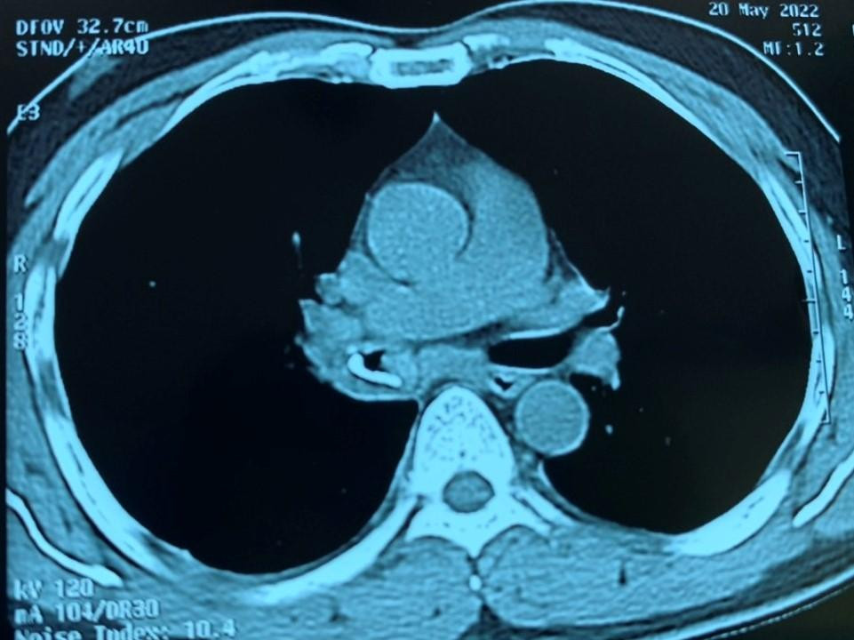 Kết quả kiểm tra hình ảnh ghi nhận dị vật nằm ở phế quản của người bệnh