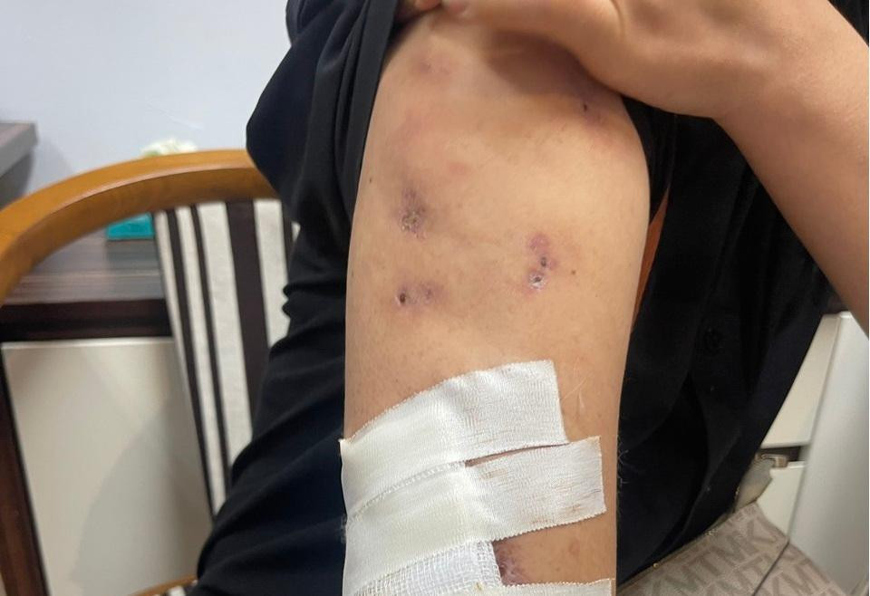 Những vị trí trên cơ thể bệnh nhân sau khi chích kim bơm chất tan mỡ đều nhiễm trùng hoại tử Những vị trí trên cơ thể bệnh nhân sau khi chích kim bơm chất tan mỡ đều nhiễm trùng hoại tử