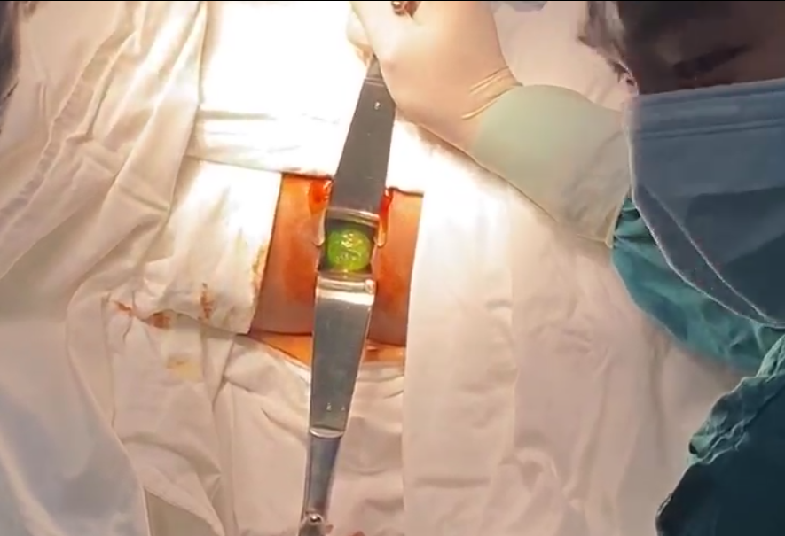 Các bác sĩ đã phải tiến hành gây mê, nong hậu môn của người bệnh để lấy dị vật ra ngoài Các bác sĩ đã phải tiến hành gây mê, nong hậu môn của người bệnh để lấy dị vật ra ngoài