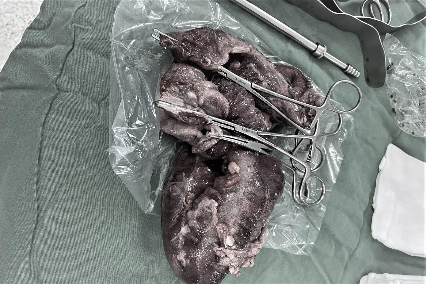 Các bác sĩ buộc phải cắt đại tràng của bệnh nhi, loại bỏ triệt để ổ nhiễm trùng