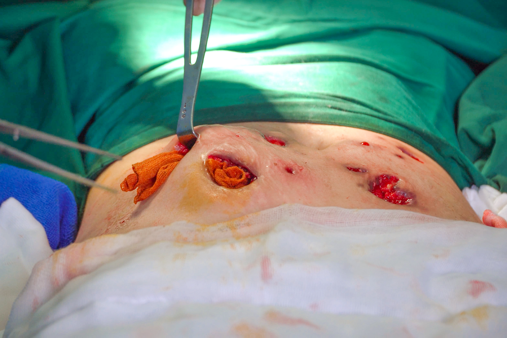 15 ổ nhiễm trùng hoại tử, trào mủ trên vùng bụng bệnh nhân sau tiêm thuốc tan mỡ