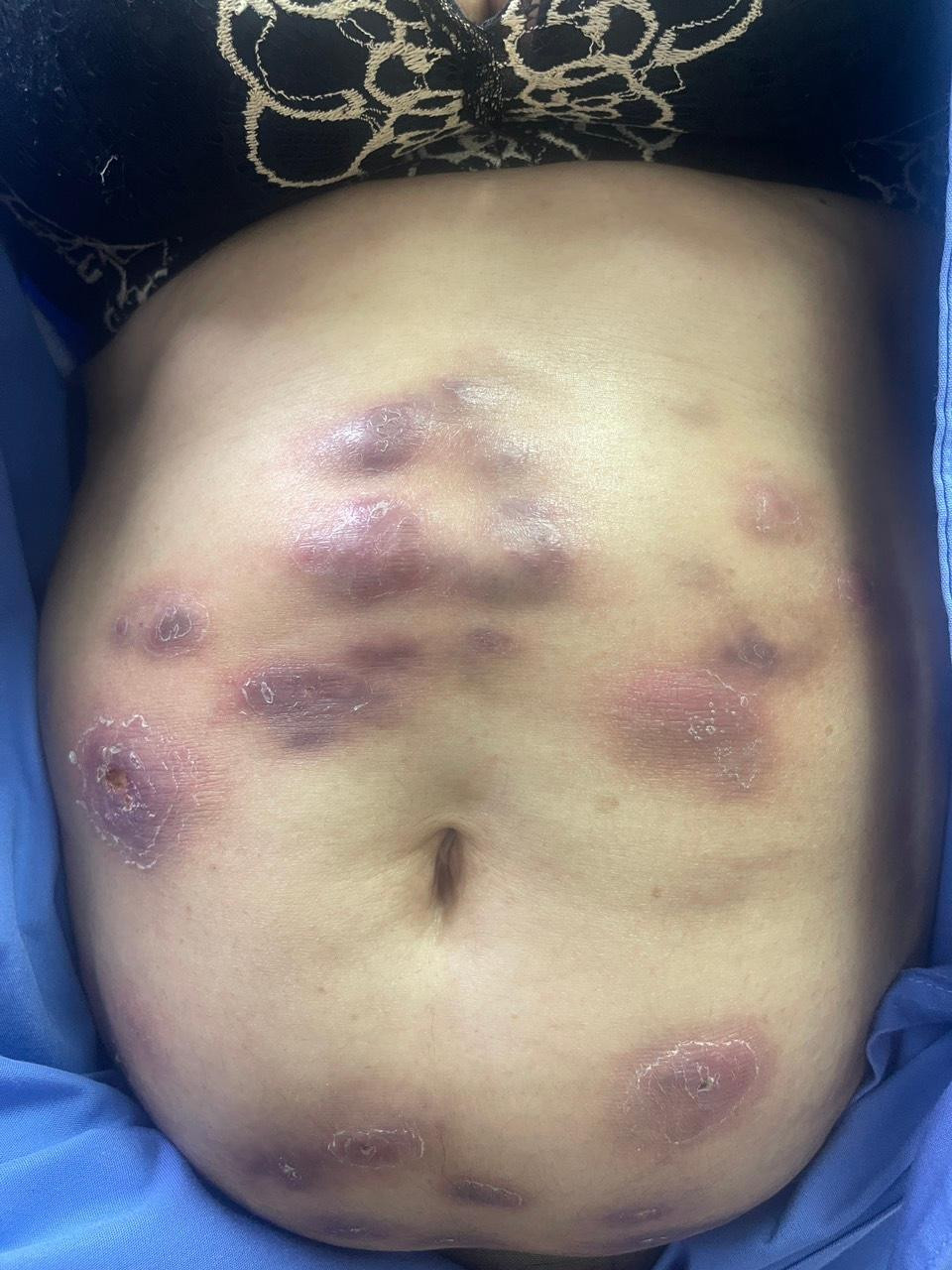 Vùng bụng của nữ bệnh nhân xuất hiện nhiều ổ nhiễm trùng, hoại tử nghiêm trọng Vùng bụng của nữ bệnh nhân xuất hiện nhiều ổ nhiễm trùng, hoại tử nghiêm trọng