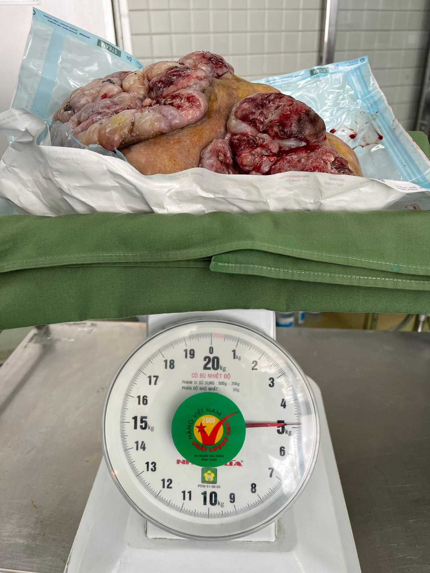 Trọng lượng khối u sau kho bóc tách khỏi cơ thể có cân nặng lên tới 5kg Trọng lượng khối u sau kho bóc tách khỏi cơ thể có cân nặng lên tới 5kg