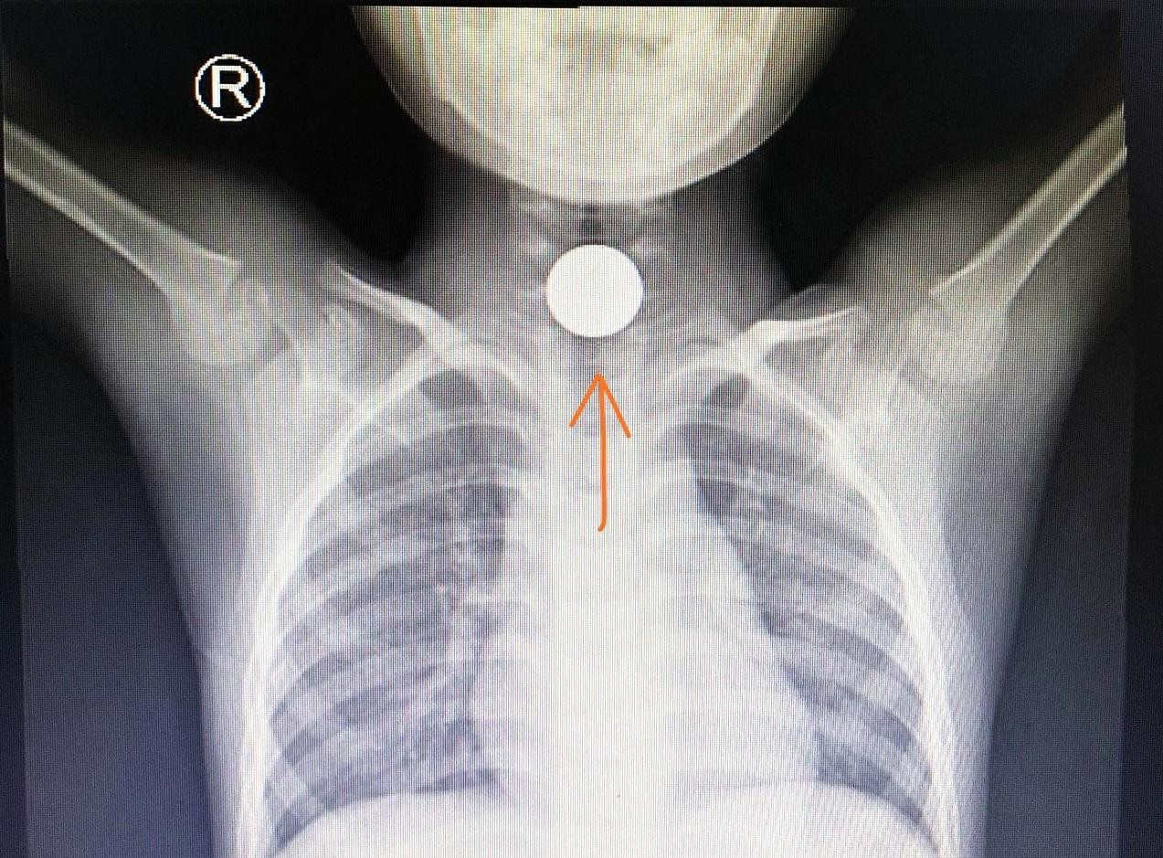 Hóc dị vật là tai nạn thường gặp ở trẻ em trong những ngày Tết, phụ huynh cần đặc biệt lưu ý Hóc dị vật là tai nạn thường gặp ở trẻ em trong những ngày Tết, phụ huynh cần đặc biệt lưu ý