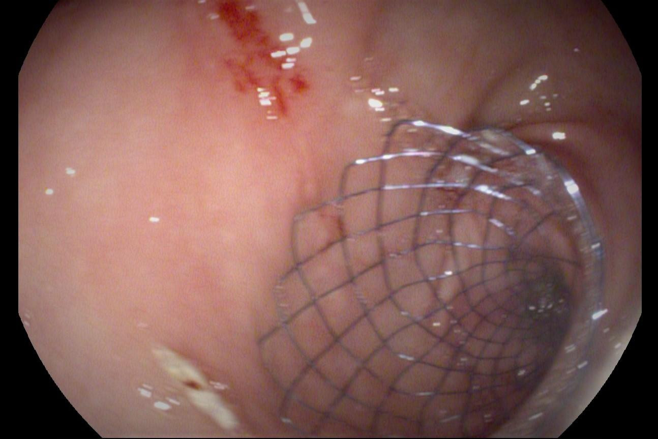 Stent là giá đỡ dạng khung kim loại được đặt thành công vào lòng ruột, khai thông vị trí tắc nghẽn cho bệnh nhân Stent là giá đỡ dạng khung kim loại được đặt thành công vào lòng ruột, khai thông vị trí tắc nghẽn cho bệnh nhân