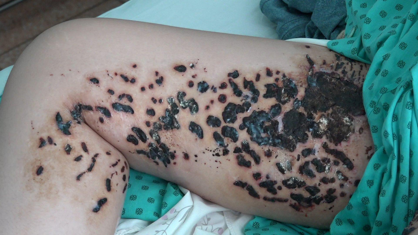 Vùng đùi của bệnh nhân bị tổn thương nghiêm trọng sau khi cơ sở spa đốt điện trị rạn da Vùng đùi của bệnh nhân bị tổn thương nghiêm trọng sau khi cơ sở spa đốt điện trị rạn da