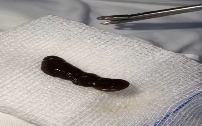 Con vắt dài 4cm sau khi được bác sĩ nội soi gắp ra từ hốc mũi bệnh nhi (ảnh: BVCC) Con vắt dài 4cm sau khi được bác sĩ nội soi gắp ra từ hốc mũi bệnh nhi (ảnh: BVCC)