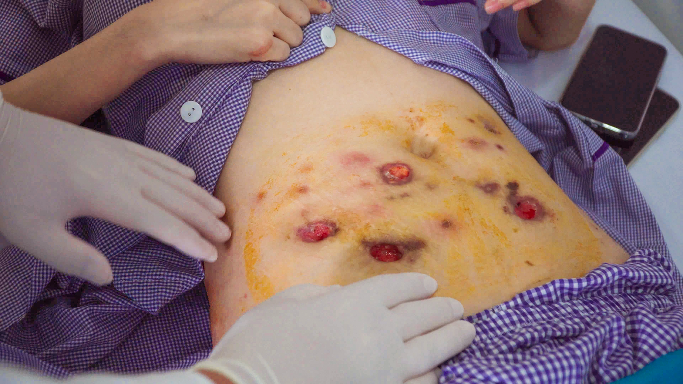 Bệnh viện JW từng tiếp nhận nhiều trường hợp bị biến chứng sau tiêm tan mỡ Bệnh viện JW từng tiếp nhận nhiều trường hợp bị biến chứng sau tiêm tan mỡ