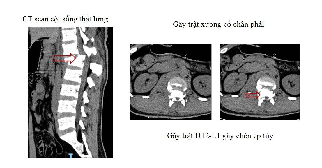 Tai nạn xảy ra khiến bệnh nhân bị vỡ đốt sống thắt lưng, gãy trật xương nhiều vị trí trên cơ thể