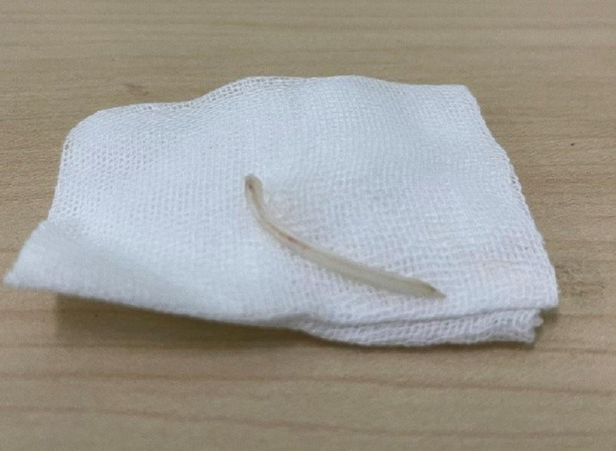 Chiếc xương được bác sĩ nội soi gắp ra ngoài thành công, giúp bệnh nhân tránh biến chứng nguy hiểm Chiếc xương được bác sĩ nội soi gắp ra ngoài thành công, giúp bệnh nhân tránh biến chứng nguy hiểm