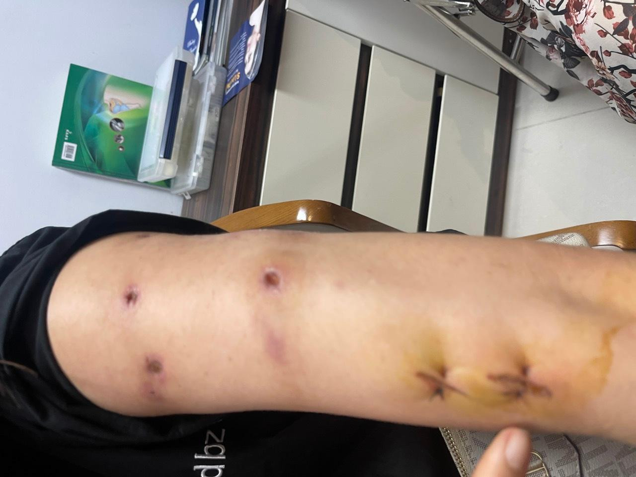 Dù đã được phẫu thuật nhiều lần nhưng tình trạng nhiễm trùng, áp xe trên cơ thể bệnh nhân vẫn tái phát Dù đã được phẫu thuật nhiều lần nhưng tình trạng nhiễm trùng, áp xe trên cơ thể bệnh nhân vẫn tái phát