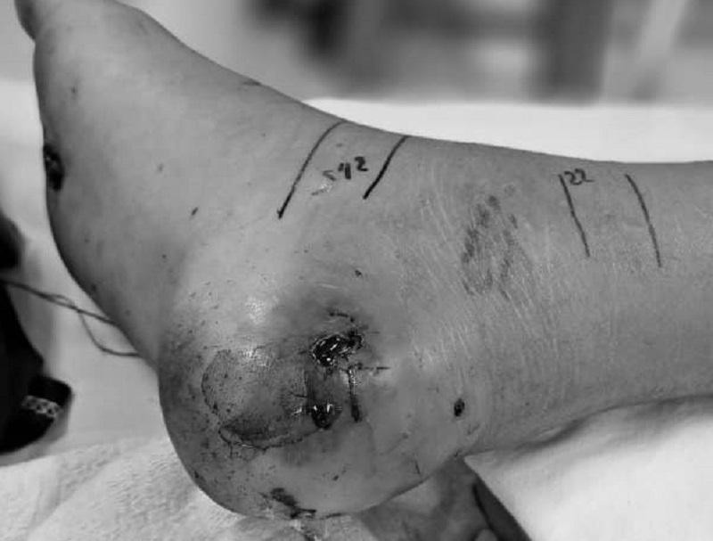 Vết thương bị rắn độc cắn nhiễm trùng nặng sau khi đắp lá tự điều trị Vết thương bị rắn độc cắn nhiễm trùng nặng sau khi đắp lá tự điều trị