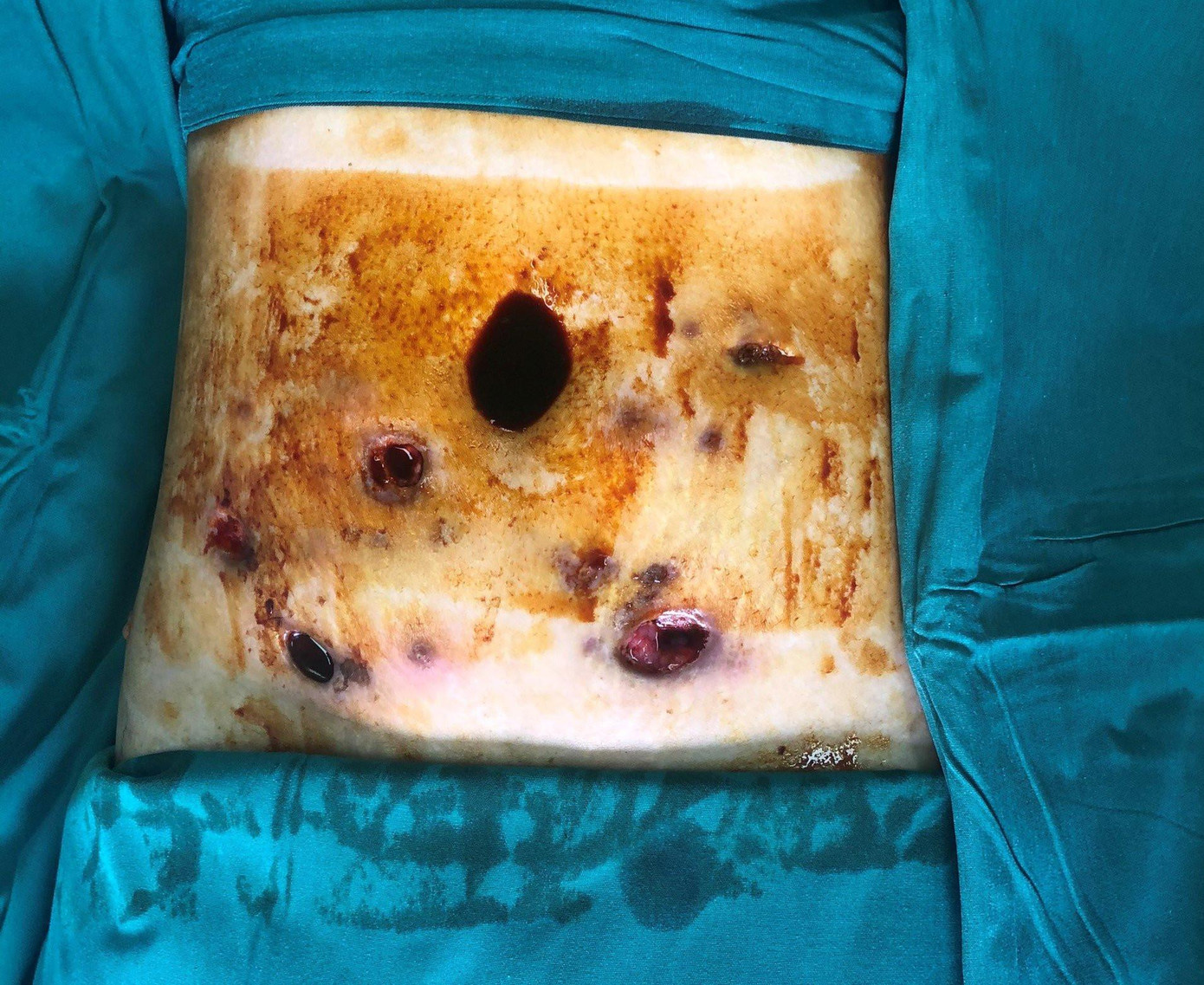 Trường hợp bị hoại tử vùng bụng được bác sĩ phẫu thuật vào đầu tháng 3/2022 Trường hợp bị hoại tử vùng bụng được bác sĩ phẫu thuật vào đầu tháng 3/2022