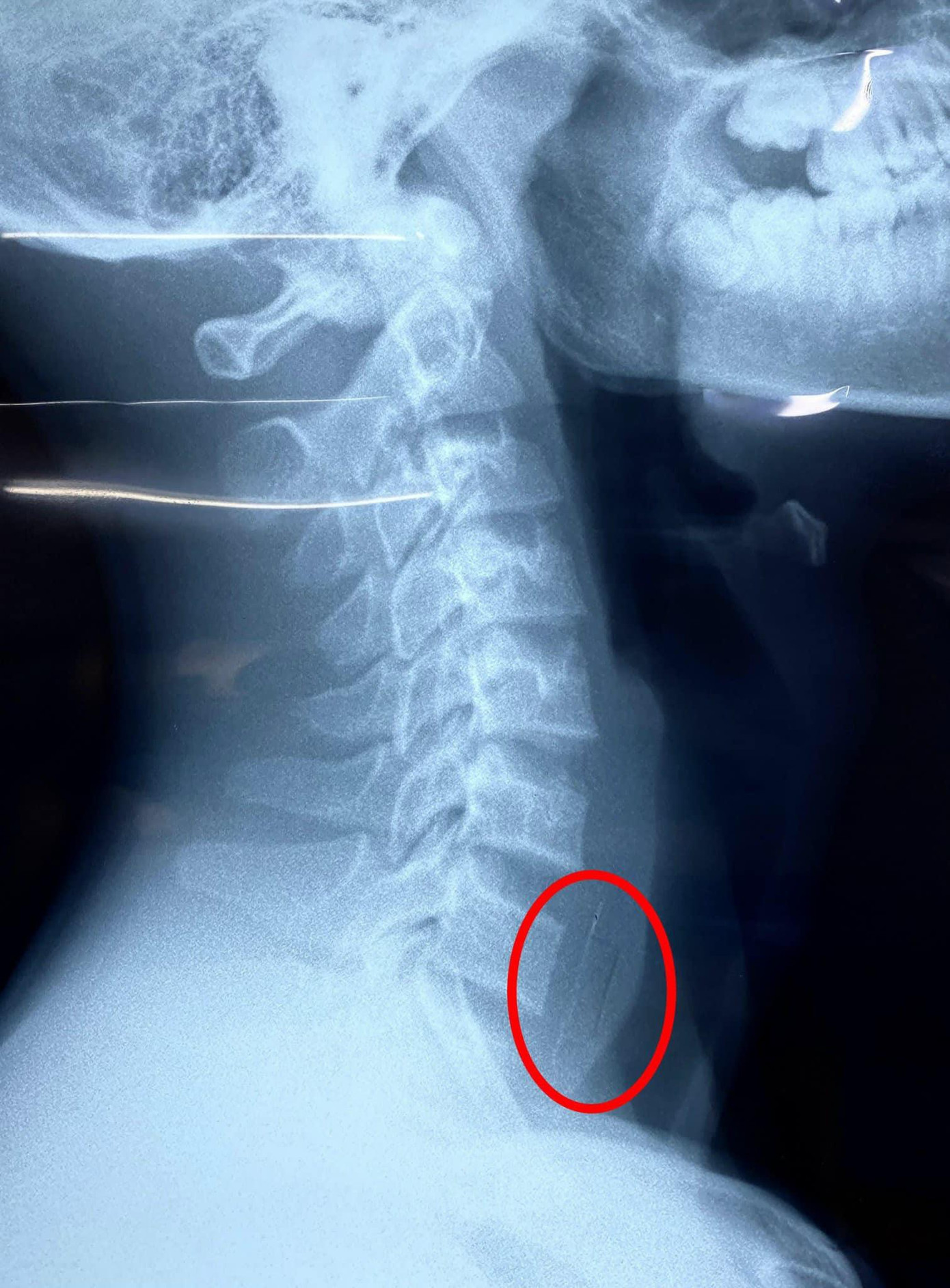 Vị trí viên thuốc còn nguyên vỏ bị kẹt lại ở vùng thực quản của bệnh nhi Vị trí viên thuốc còn nguyên vỏ bị kẹt lại ở vùng thực quản của bệnh nhi