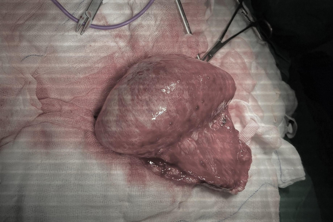 Vị trí đại tràng bị hoại tử, thủng phân thoát vào ổ bụng khiến bệnh nhi bị nhiễm trùng, nhiễm độc